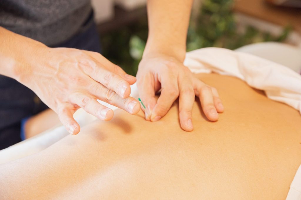 Acupuncture needles along a patient's back