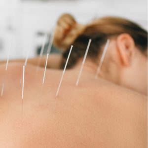 A woman relaxing during an acupuncture treatment