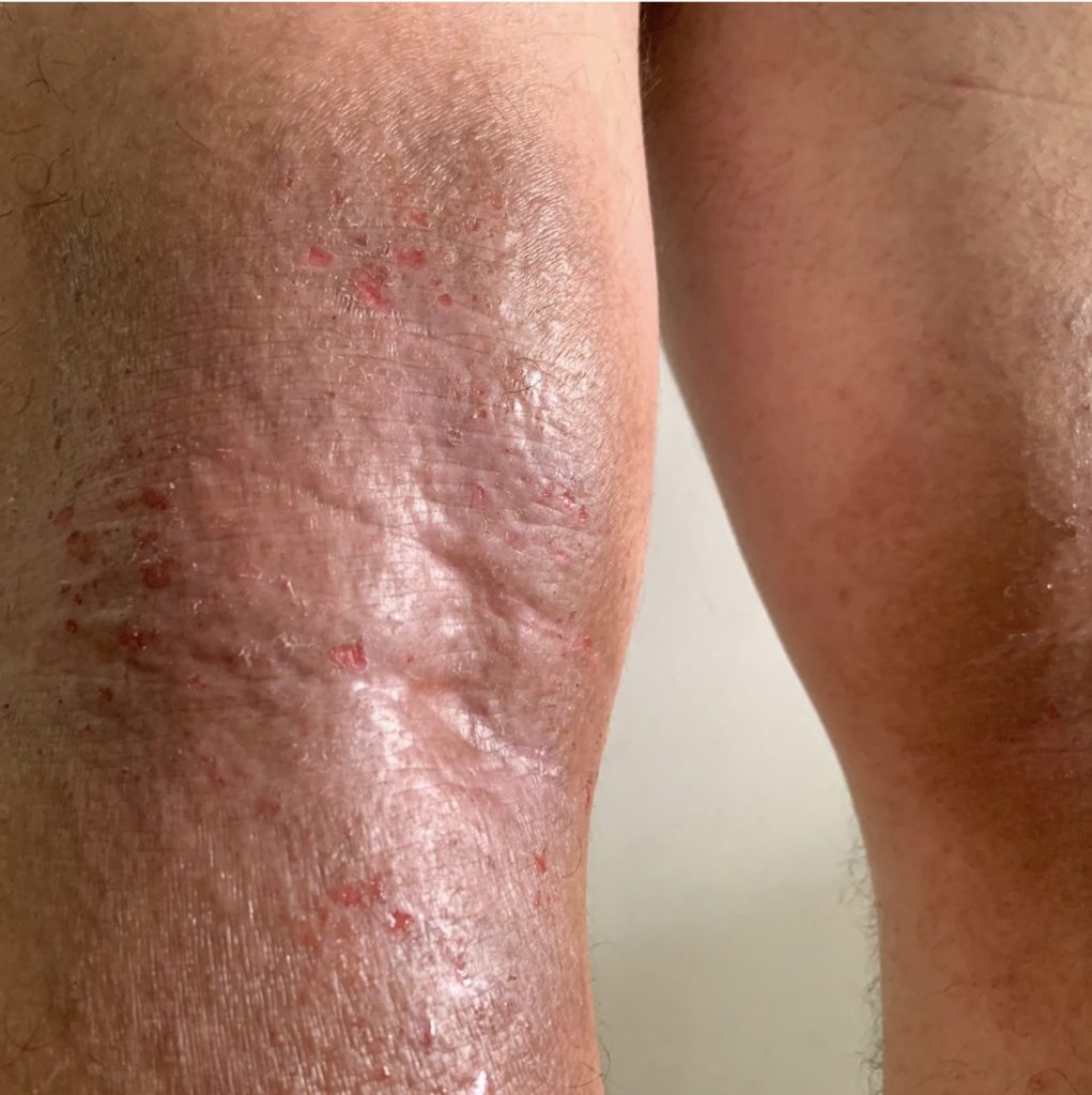 Close-up of dry, irritated skin affected by eczema