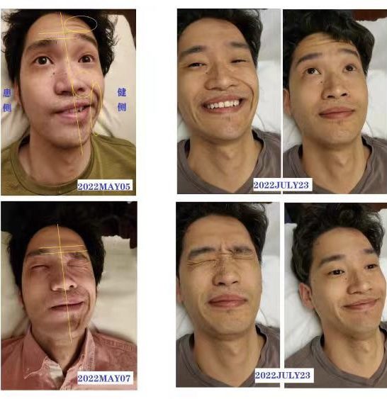 Dated progress photos showing Michael's facial movement improving between May and July 2022
